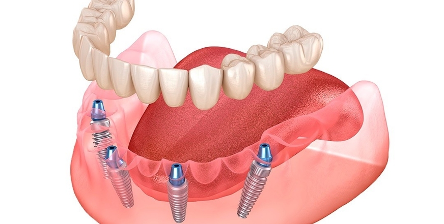 Имплантация по системе «все на 4»